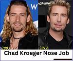 Chad Kroeger Cosmetic Surgery: Unveiling the Transformation