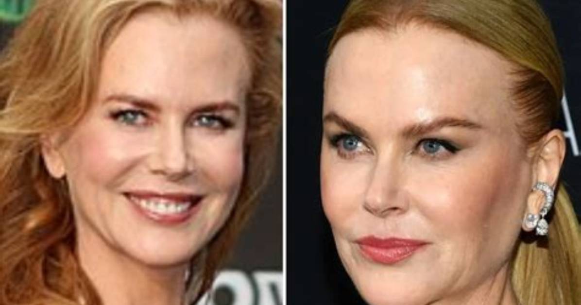 Decoding the Truth: Does Nicole Kidman Have Breast Implants?