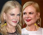 Dr Nicole Kidman's Facelift - Did She Get It?