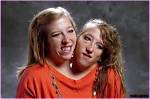 Tragic Loss: Conjoined Twins, Abby and Brittany, Succumb to Pregnancy Complications